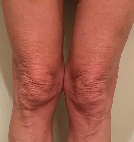 Subject 3, seen before Morpheus8 treatment by Dr. F. Roth.