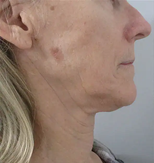 Subject 5, seen before Morpheus8 treatment by Dr. S. Harper