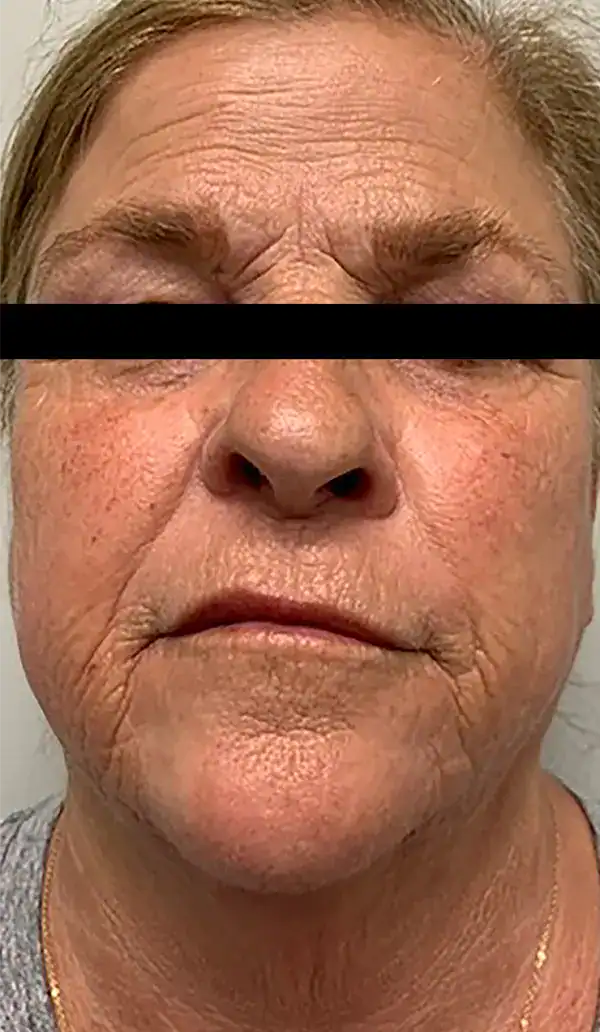 Subject 6, seen before Morpheus8 treatment by Dr. S. Harper