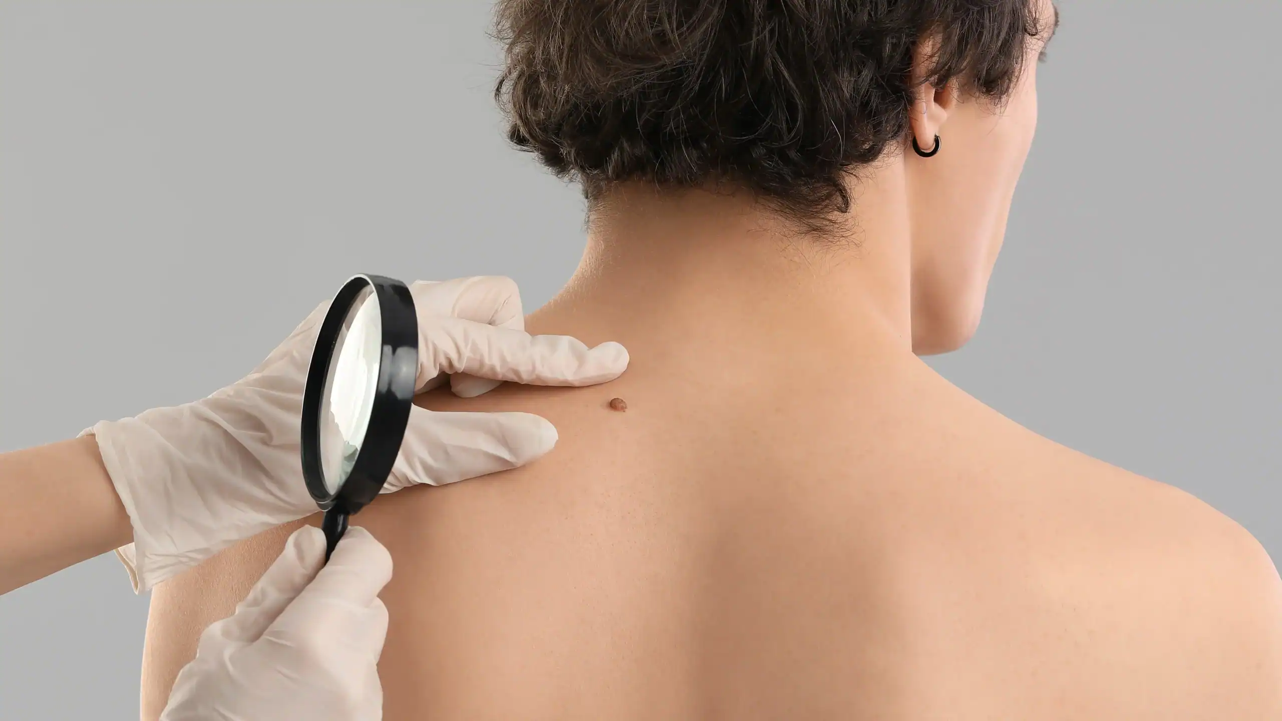 Young man gets moles on his back checked by surgical dermatologist